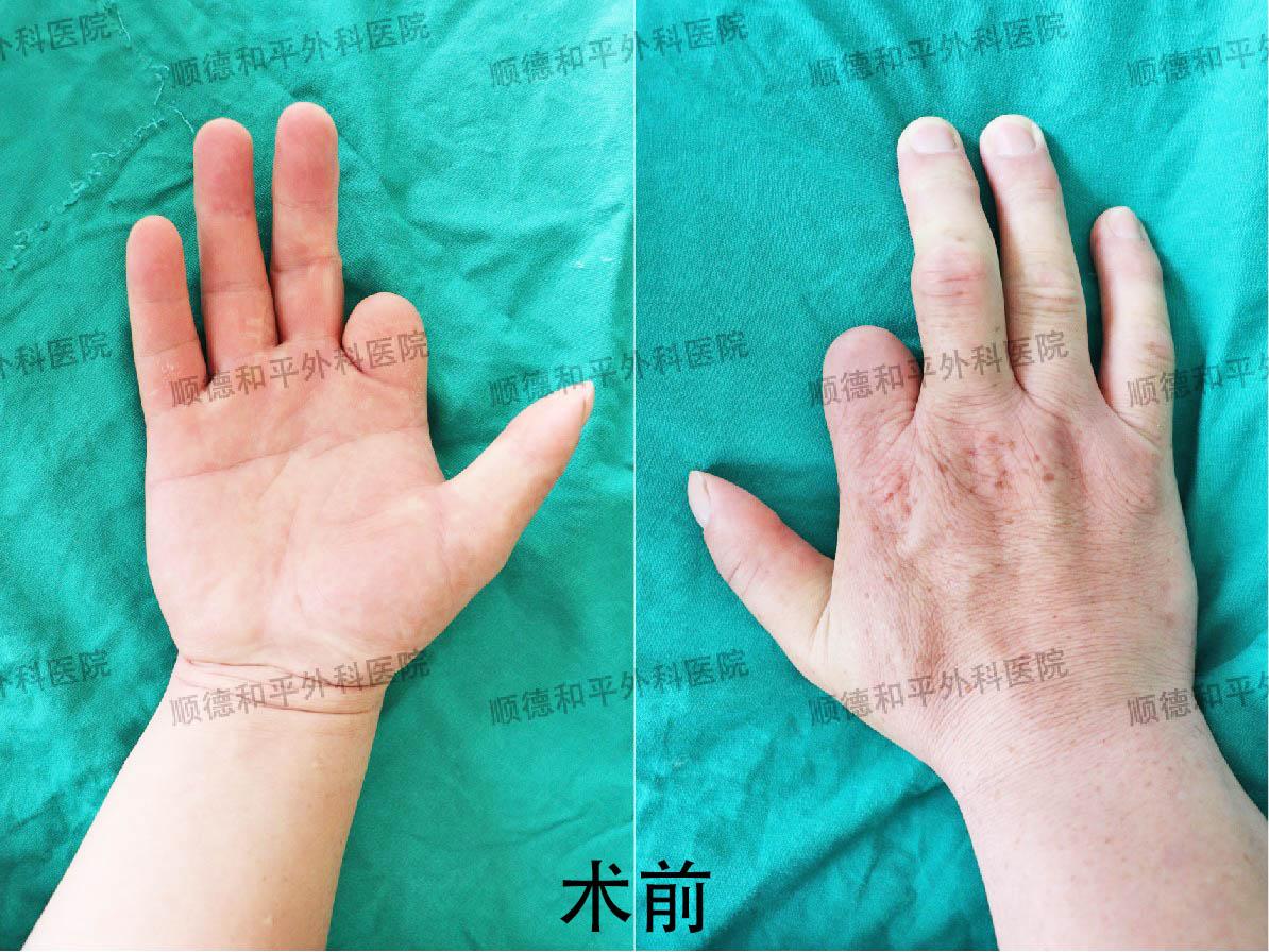新疆患者失去手指心生自卑，遠赴廣東手指再造＿手外科醫(yī)院咨詢(圖1)