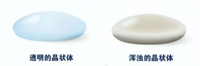 愛(ài)爾眼科：白內(nèi)障不會(huì)“缺席”只會(huì)“遲到”？(圖3)